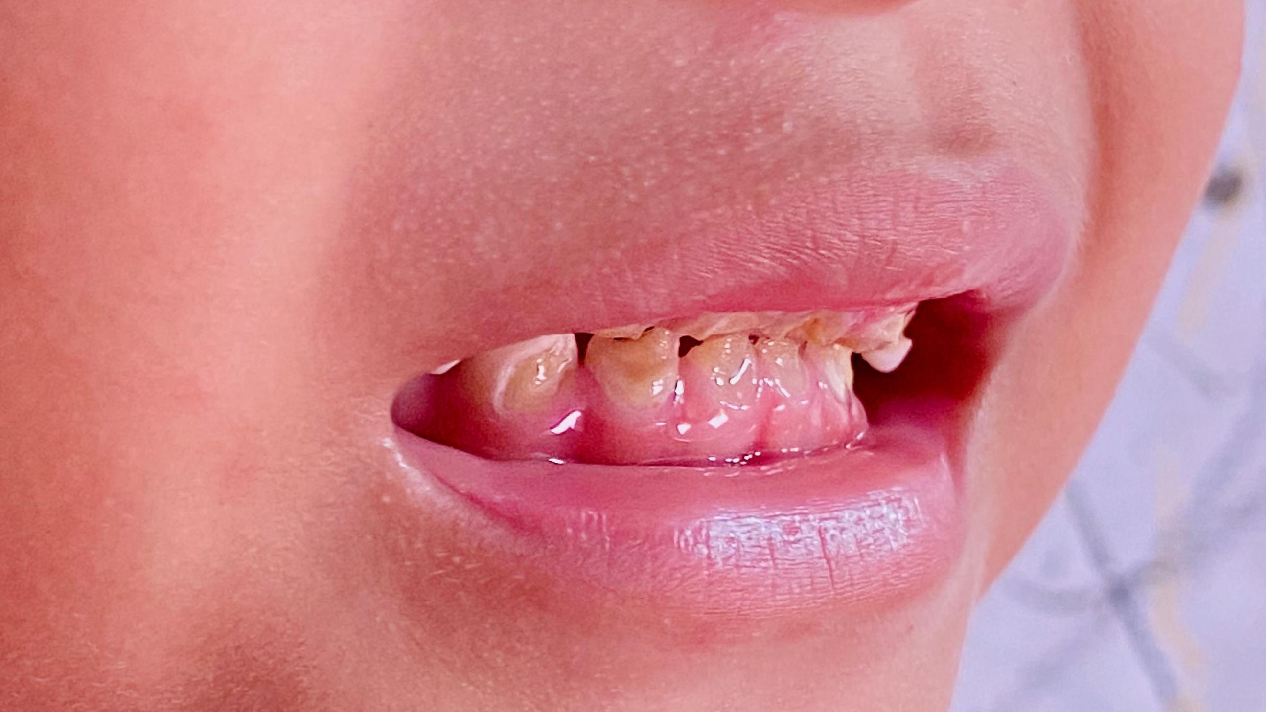 صورة مقرّبة لأسنان طفل صغير تُظهر علامات التسوّس. 