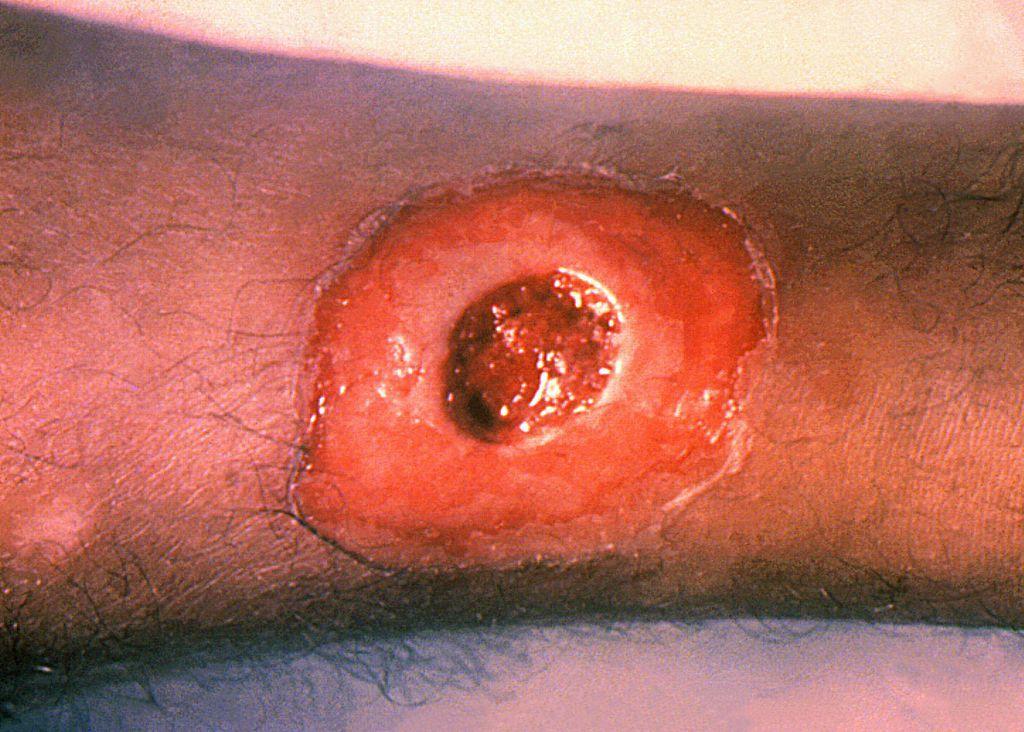 دفتيريا جلدية تظهر على شكل جرح مفتوح على ساق حيث يمكن لبكتيريا Corynebacterium diphtheriae أن تؤثر ليس فقط على الجهاز التنفسي، بل على الجلد أيضاً