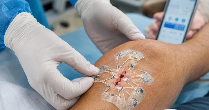 هل تقترب نهاية الغرز الجراحية؟ تقنية صينية جديدة تُغلق الجروح عبر الهاتف الذكي!
